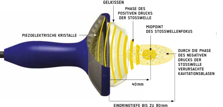 Hier sehen Sie das Produkt Swiss PIEZOCLAST aus der Kategorie Guides DolorClast® Therapie