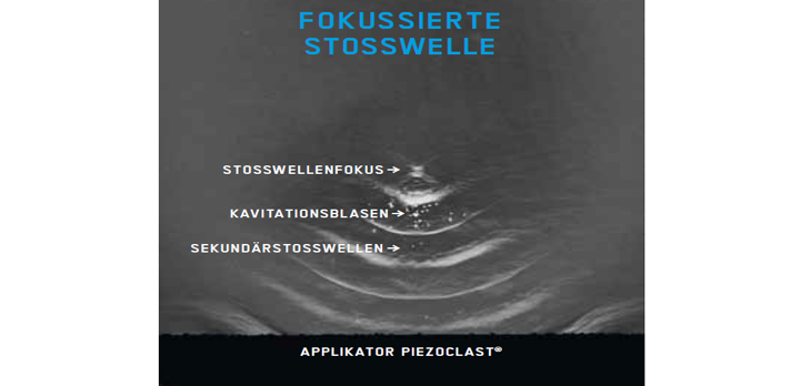 Hier sehen Sie das Produkt Swiss PIEZOCLAST aus der Kategorie Guides DolorClast® Therapie